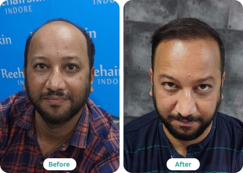 Yushuf pathan hair transplant result